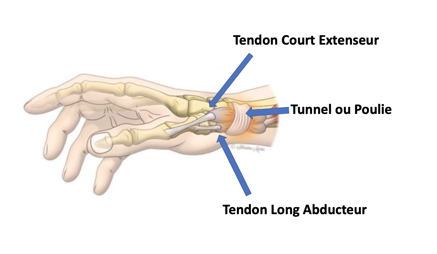 Ténosynovite De Quervain, tenosynovite du pouce : éviter la récidive