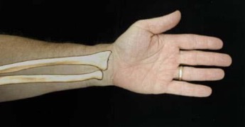 Ostéosynthèse par plaque vissée d'une fracture du radius distal ...